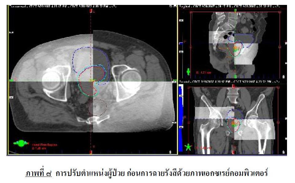 ไฟล์:การปรับตำแหน่งผู้ป่วย ก่อนการฉายรังสีด้วยภาพเอกซเรย์คอมพิวเตอร์.JPG