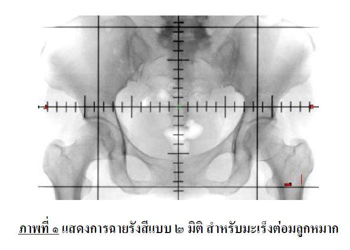 ไฟล์:แสดงการฉายรังสีแบบ ๒ มิติ สำหรับมะเร็งต่อมลูกหมาก.JPG