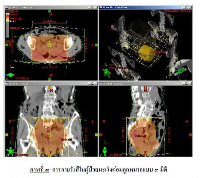 ไฟล์:การฉายรังสีในผู้ป่วยมะเร็งต่อมลูกหมากแบบ ๓ มิติ.JPG