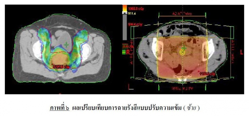 ไฟล์:ผลเปรียบเทียบการฉายรังสีแบบปรับความเข้ม (ซ้าย).JPG